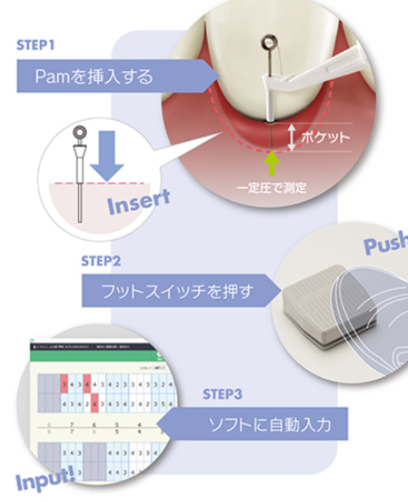 歯周ポケット自動測定装置